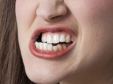 Teeth-Grinding-1